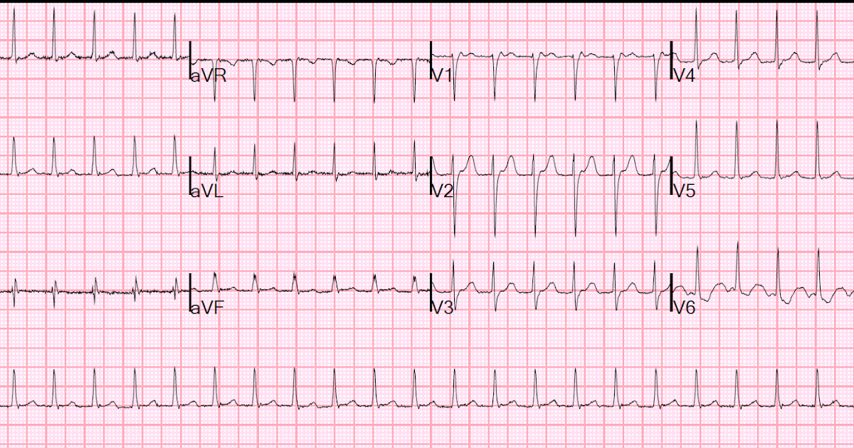 What Is Svt >> Dr. Smith's ECG Blog: An apparent SVT that does not ... What Is Svt >> Dr. Smith's ECG Blog: An apparent SVT that does not ...