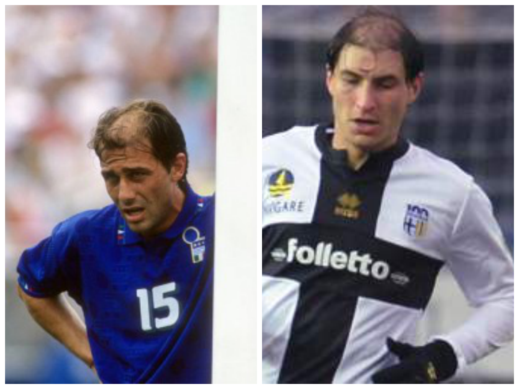 Dove Ha Fatto Il Trapianto Di Capelli Antonio Conte
