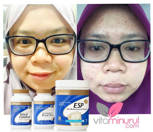 rawat jerawat dengan vitamin c shaklee rawat jerawat dengan vitamin c shaklee