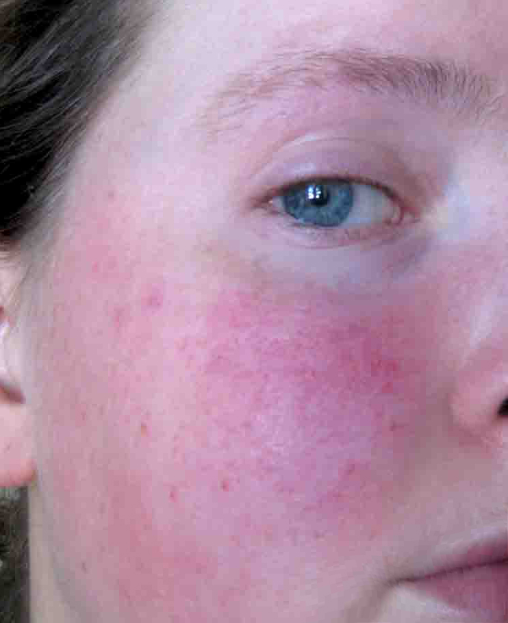 Scarlet Letters, dealing with vascular rosacea, face flushing, burning