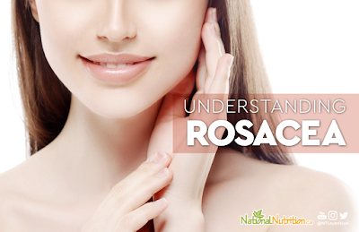  Natural Health Tips For Rosacea