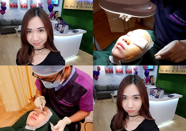 double eyelid procedure DST ME Aesthetic Clinic KL Malaysia Review