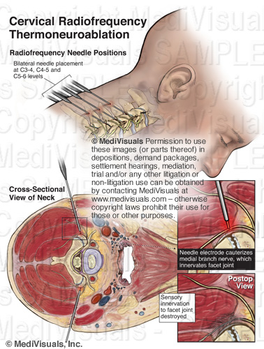Discography Injection The Medical Legal Exhibit Expert Blog: