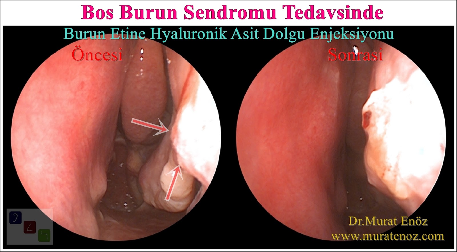 Boş Burun Sendromu Tedavisinde Burun Etine Hyaluronik Asit Enjeksiyonu