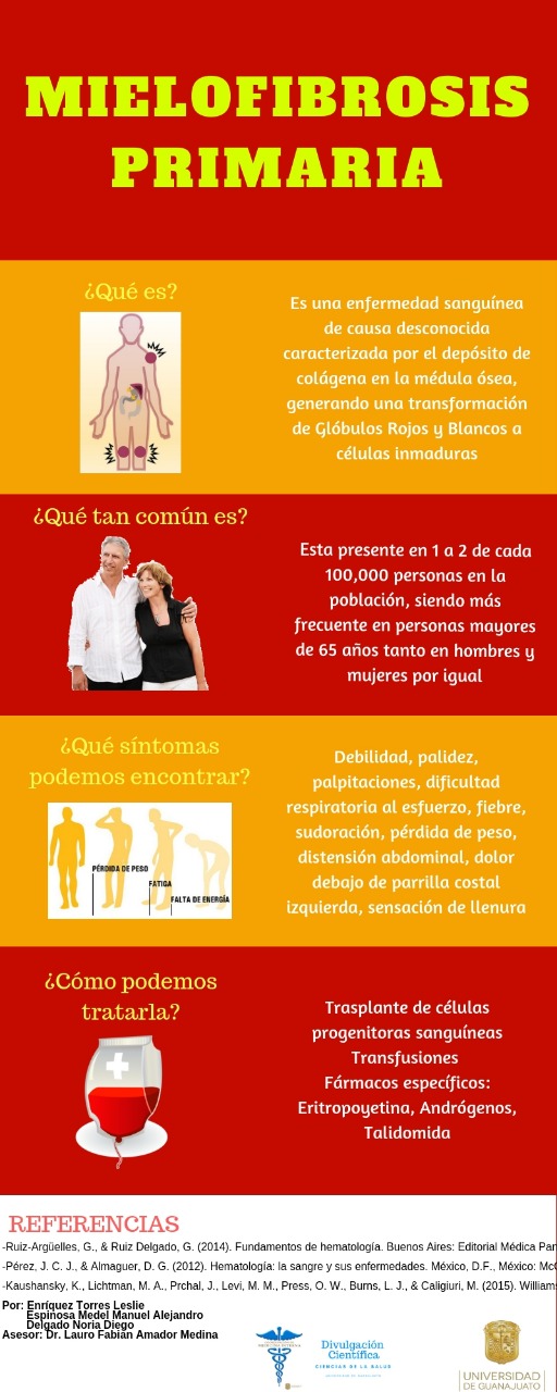 La mielofibrosis produce perdida de peso y sueno