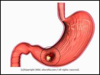 Gastric cancer treatment, Gastric cancer, causes for cancer