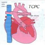 TCPC
