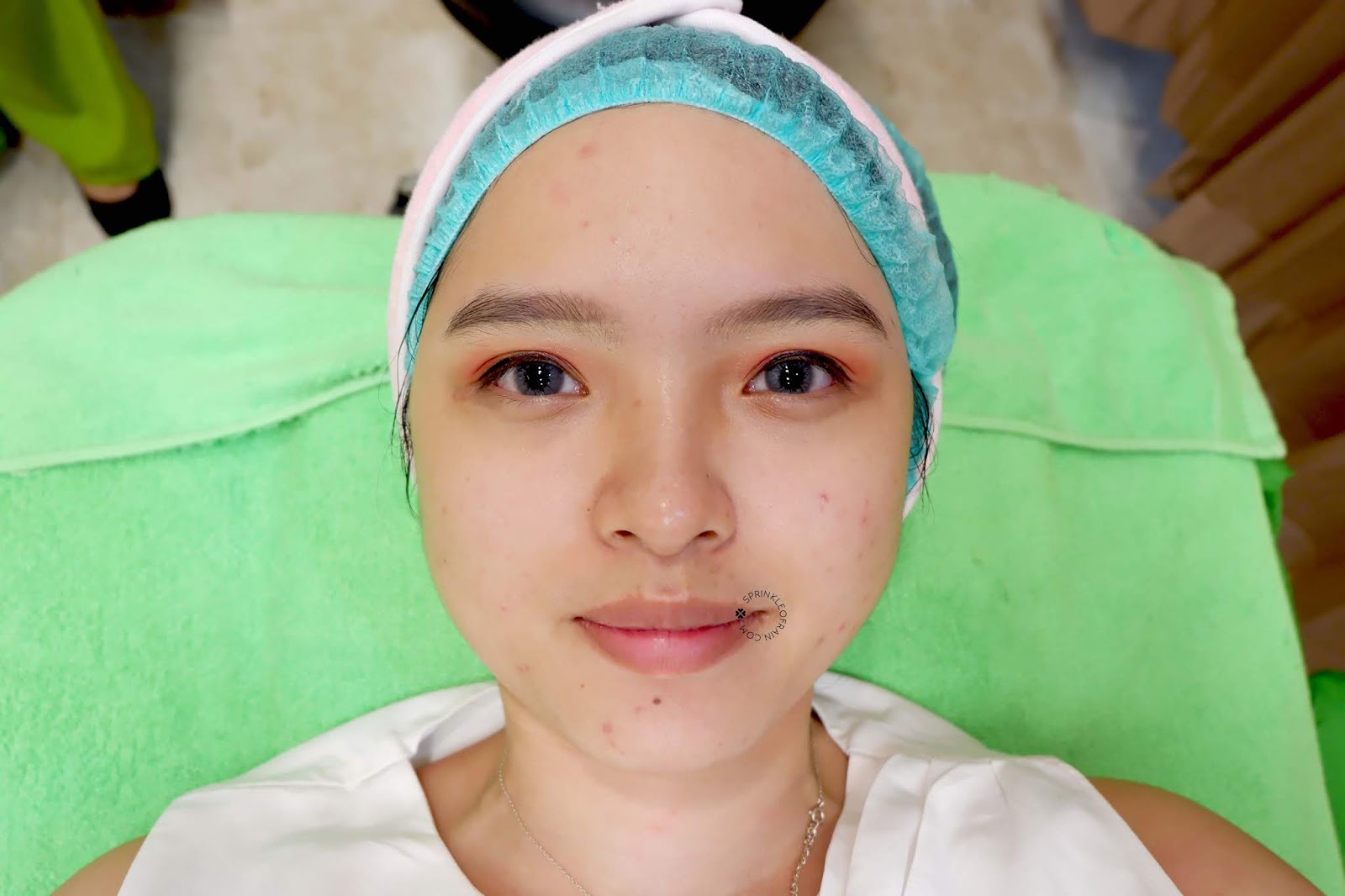 [REVIEW] Treatment Photo Facial Acne di ZAP Clinic Sprinkle of Rain