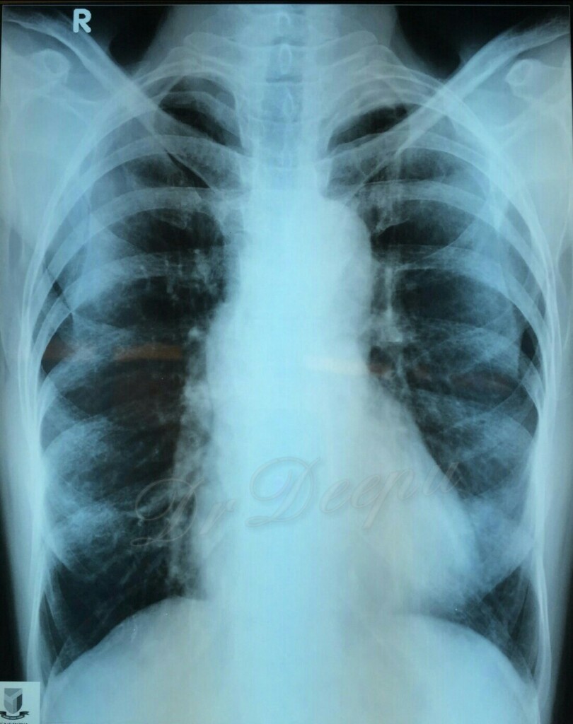 Chest Archives Chest X Ray chronic eosinophilic pneumoniae