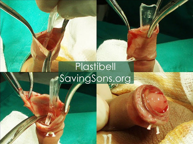 Ring Circumcision Falling Off Ring Circumcision Falling Off