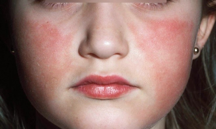 Fifth Disease Pictures and Treatment - eMedicineHealth