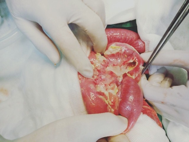 Bệnh nhi bị thủng ruột vì viêm túi ruột thừa và khuyến cáo của Bác sỹ Bệnh nhi bị thủng ruột vì viêm túi ruột thừa và khuyến cáo của Bác sỹ