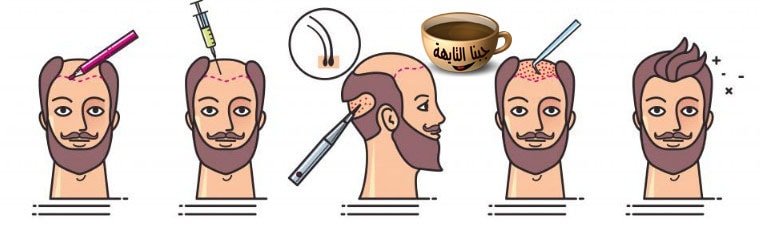زراعة الشعر في السعودية الخبر أفضل المراكز والتكلفة والأطباء