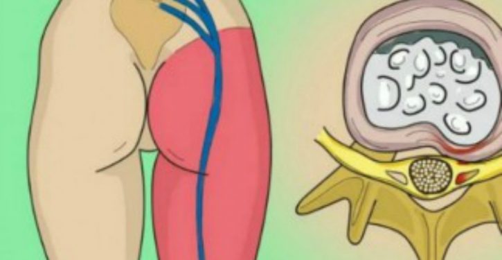 How To Relieve The Pain Of The Sciatic Nerve
