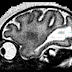 PELA 1ª VEZ, CIENTISTAS REGISTRAM LESÃO CEREBRAL POR ZIKA EM FETO DE MACACO