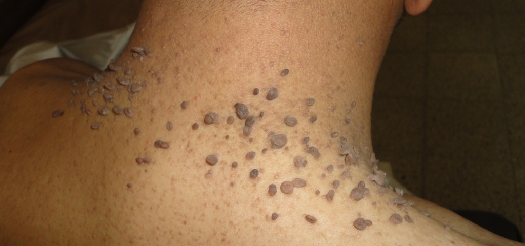 Cara Menghilangkan Skin Tag Atau Daging Tumbuh Di Kulit Leher Cara Menghilangkan Skin Tag Atau Daging Tumbuh Di Kulit Leher