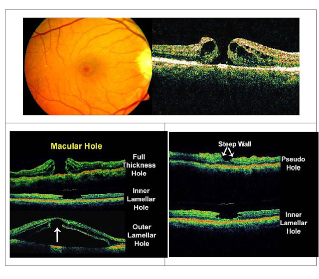 Interpretation of OCT A Basic Approach Eye Health Nepal
