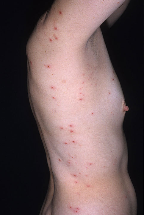 skin rashes on abdomen #11