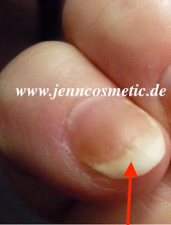 Fingernagel riecht komisch, Jenn Cosmetic fingernagelpilz Finger Krankheiten erkennen Bilder