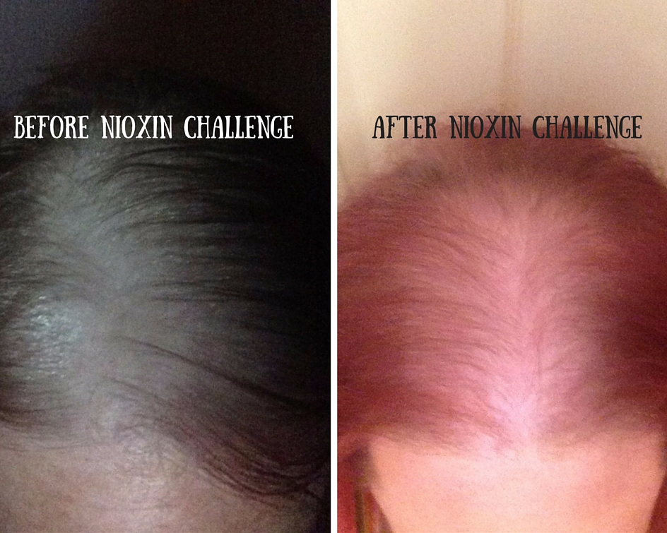 Combat Thinning Hair With The Nioxinchallenge Mommy Katie