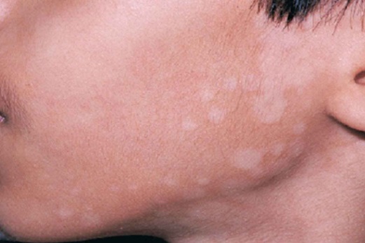 20 Jenis Penyakit Kulit di Wajah, Penyebab &amp; Gambarnya