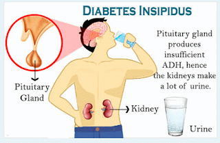 Diabetes insipidius