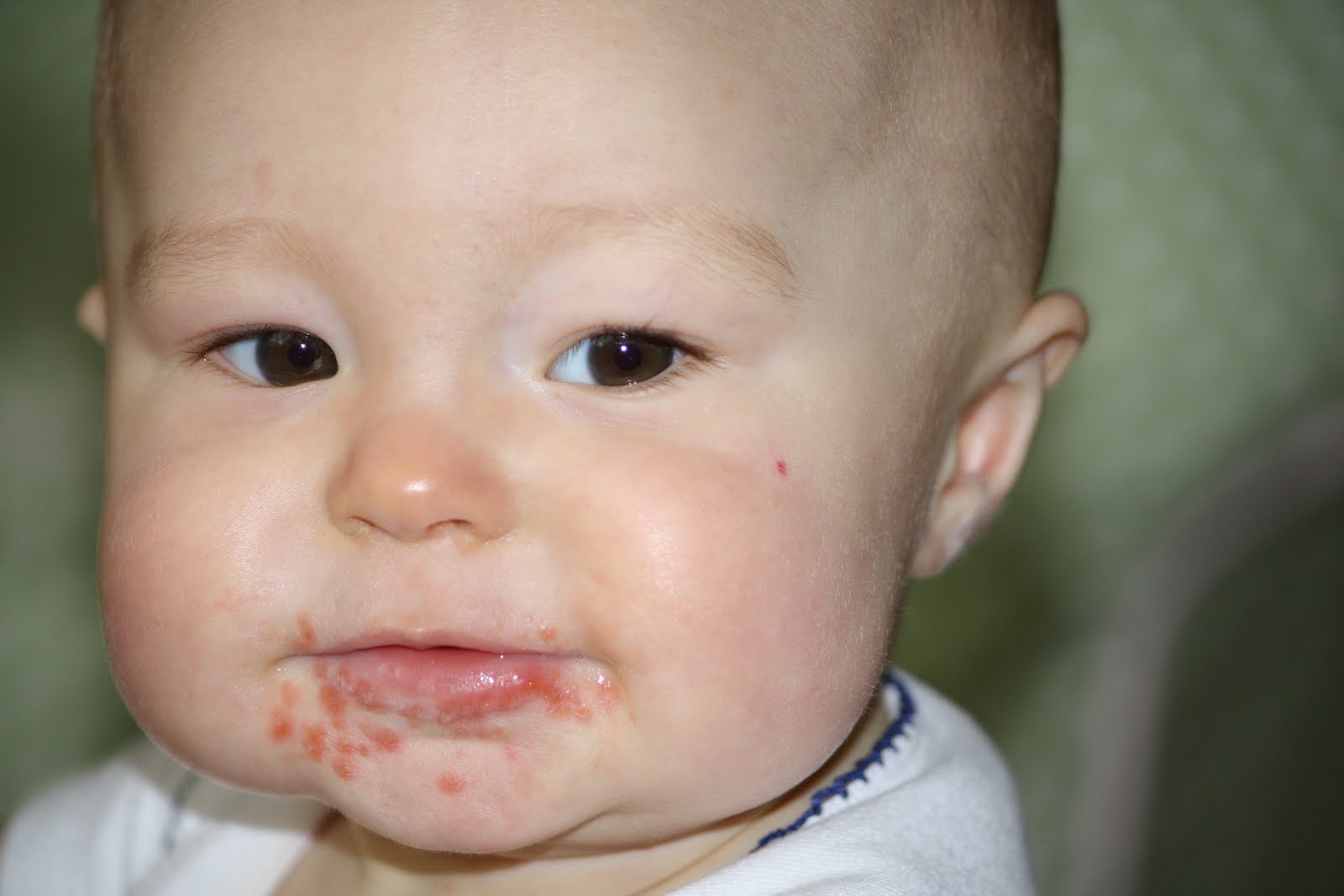 Diseases Hand Foot And Mouth Disease Contagious