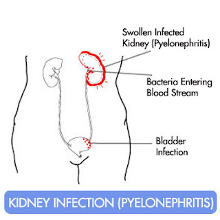 Kidney infection