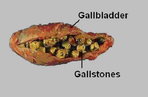 Overcome Disease: gallstone