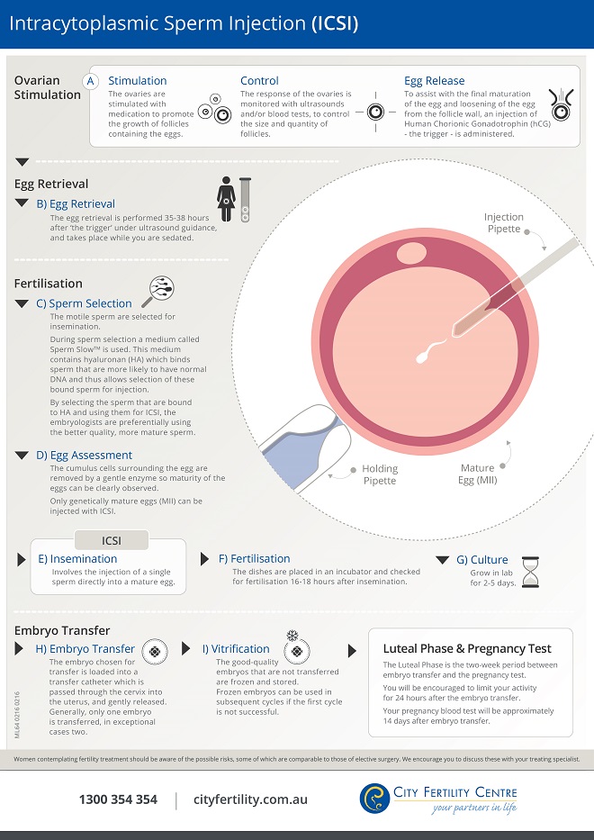 Intracytoplasmic Sperm Injection Is An Ivf Technique For Male Infertility