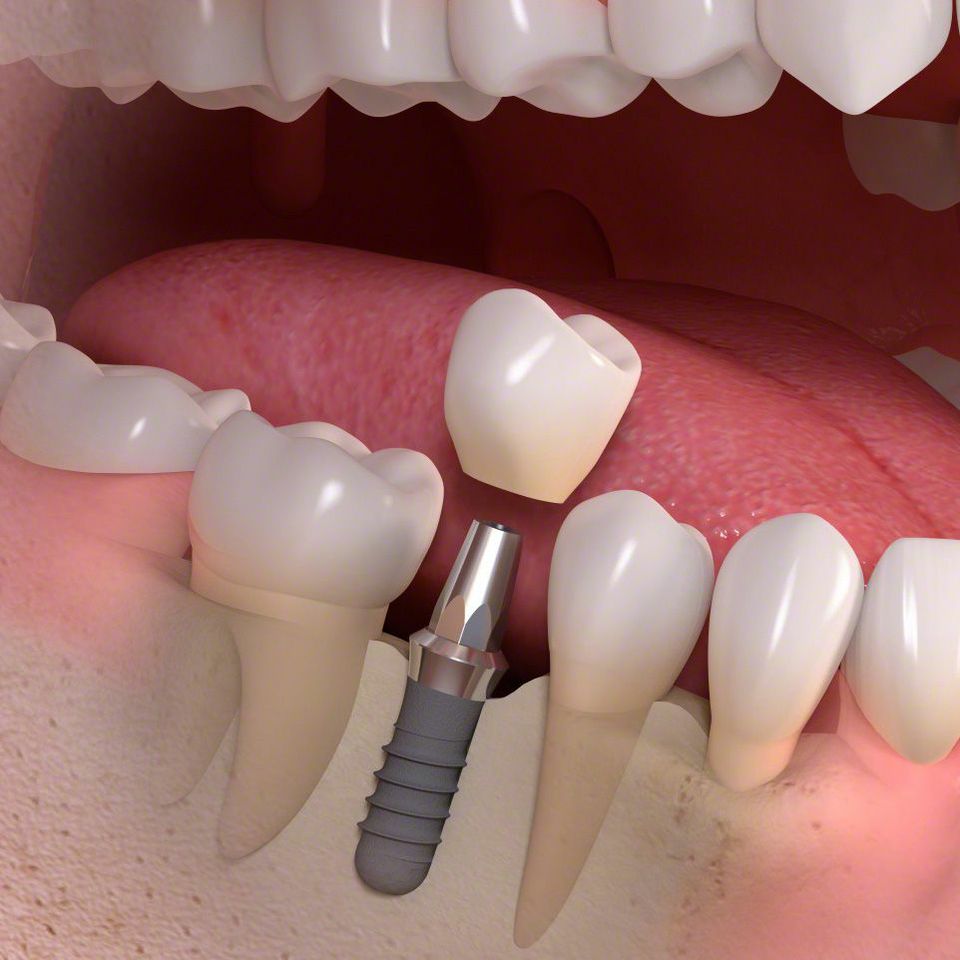 Circle Dental Care Ltd Dental Implants Look And Perform Exactly As