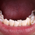 Răng bị móm do những nguyên nhân nào?