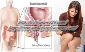 Pengobatan Herbal Buat Mengobati Ambein