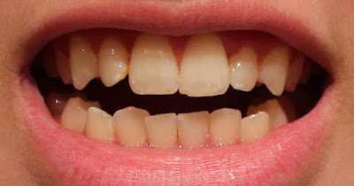 Tẩy trắng răng bị nhiễm tetracycline nên biết