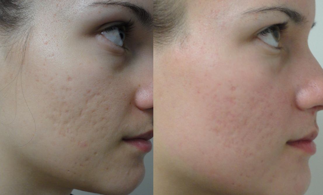 Best Acne Scars Treatment Products Acne Treatments Is Dermabrasion