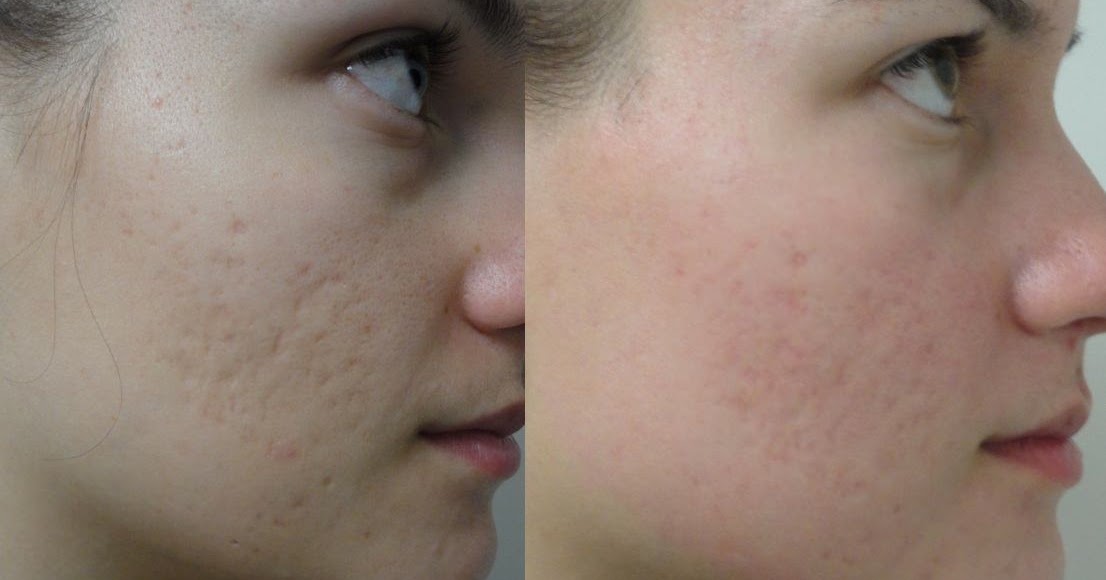 Best Acne Scars Treatment Products Acne Treatments Is Dermabrasion