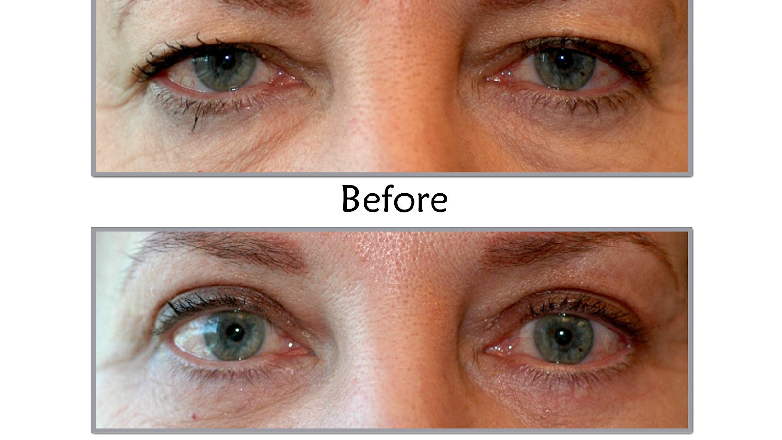 LASIK Eye Lift Recovery Lift Choices