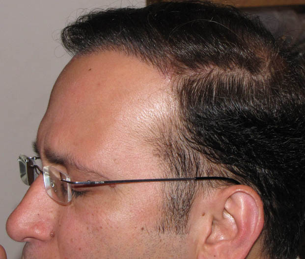 Hair transplantation and artificial synthetic hair Hair transplantation and artificial synthetic hair