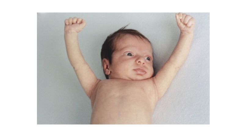 Гипотиреоз у детей клинические. Врожденный гипотиреоз у новорожденных. Врожденный гипотиреоз микседема.