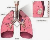 obat tbc paru tradisional