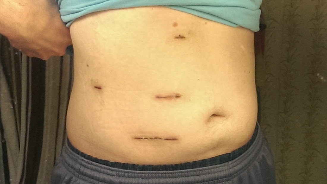 My Living Kidney Donation Experience Recovery Two Months my-living-kidney-donation-experience-recovery-two-months