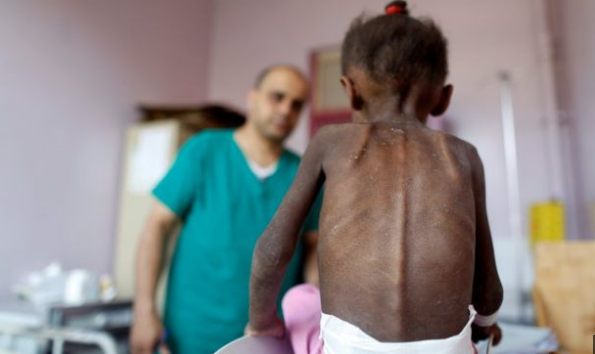 بسبب سوء التغذية؛ توفي 85000 طفل دون سن الخامسة في اليمن.