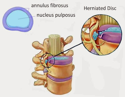 Herniated Disc