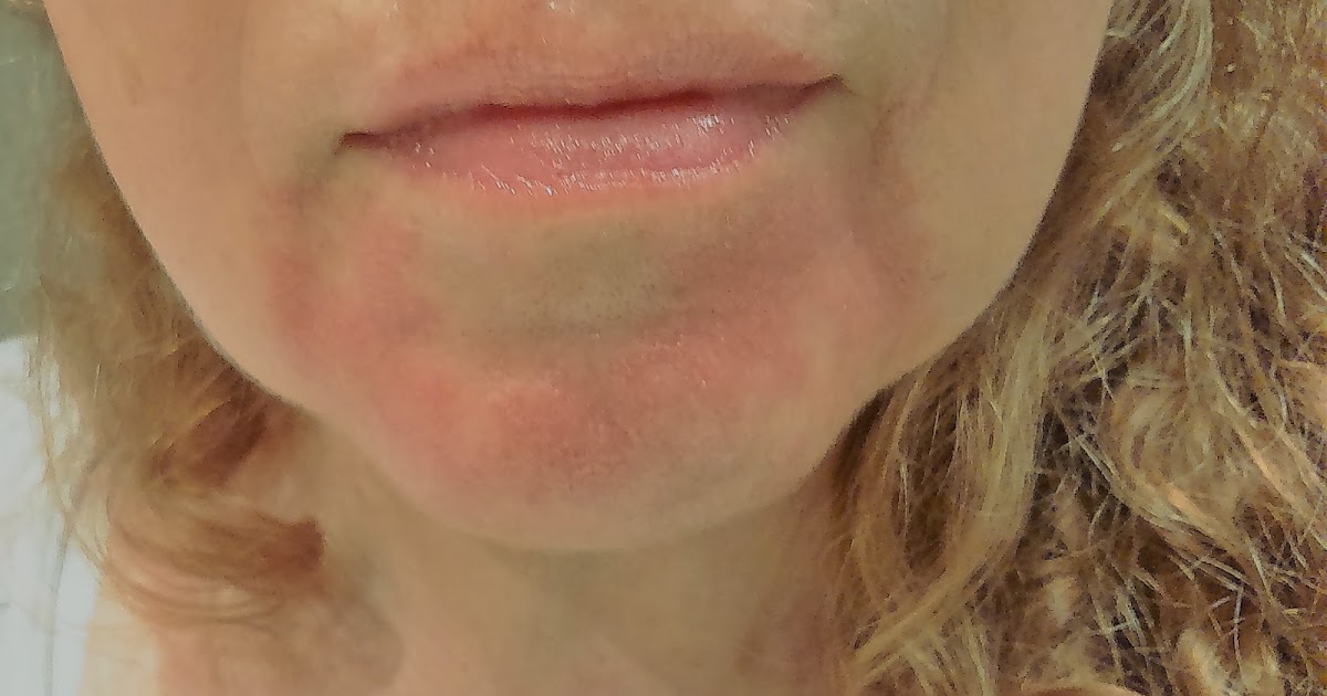 Cuidarse a los 50: Dermatitis seborreica