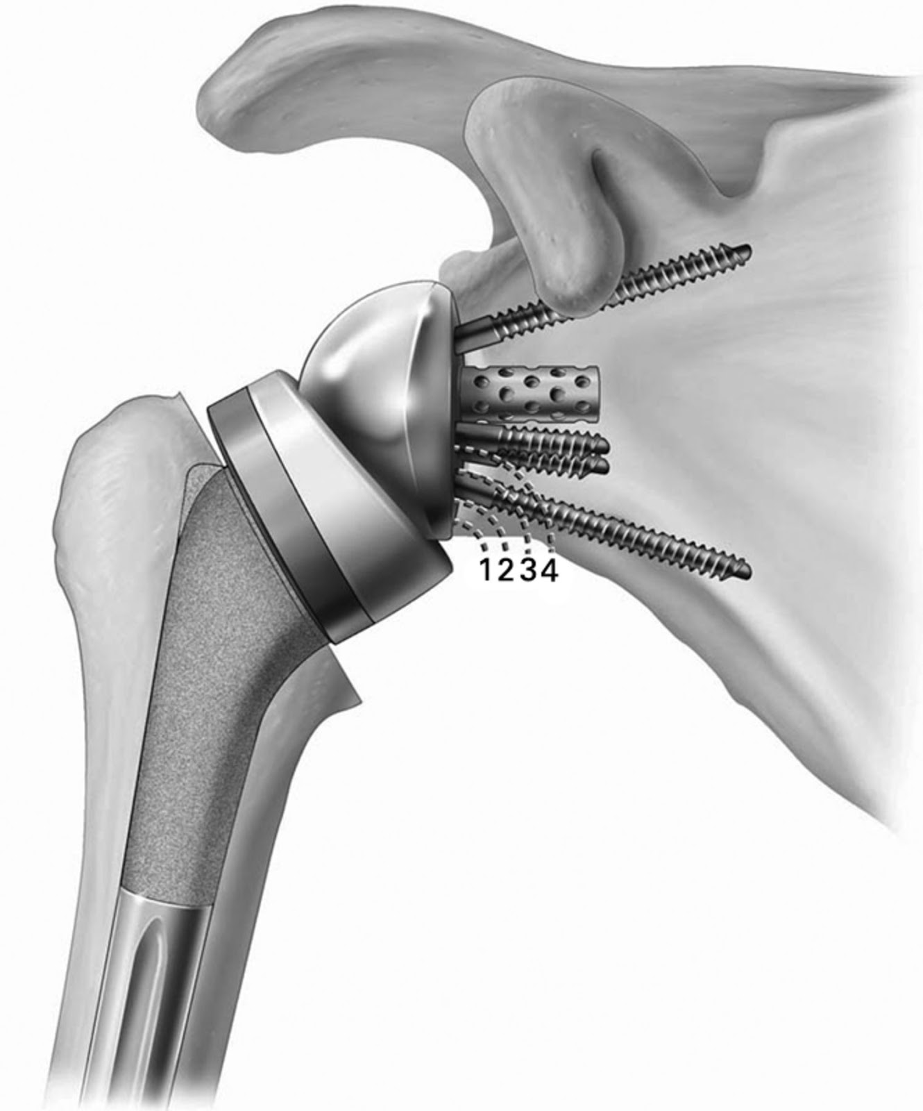 эндопротезирование локтевого сустава артропластика. импиджмент синдром плечевого сустава. F3601 фиксатор плечевого. мышцы ротаторной манжеты плечевого сустава. ортопедические нарушения.