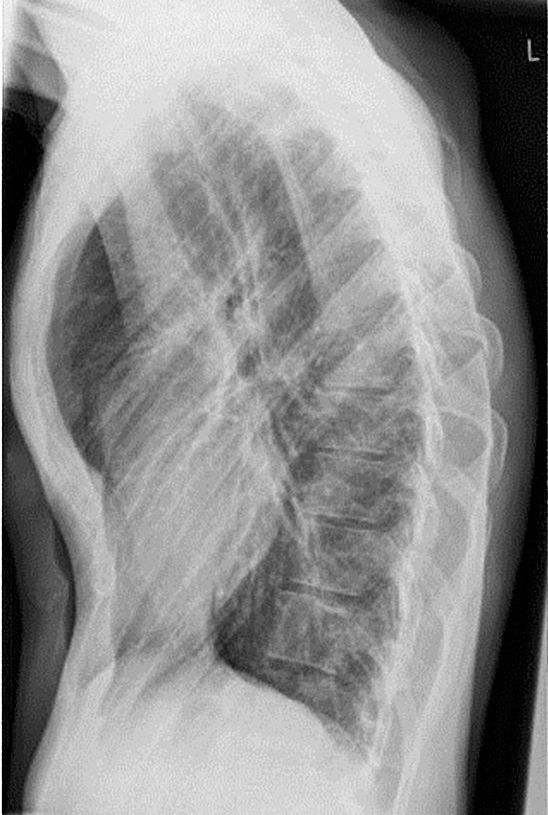 воронкообразная деформация грудной клетки кт. деформация грудной клетки рентген. деформация грудной клетки рентген. деформация грудной клетки рентген. деформация грудной клетки рентген.