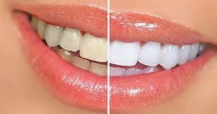 Penyebab gigi menguning tidak fresh dan segar