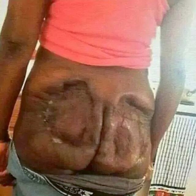 Ass Implants Gone Wrong 116