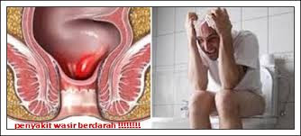 Foto Berak Berdarah Merupakan Penyakit apa ?