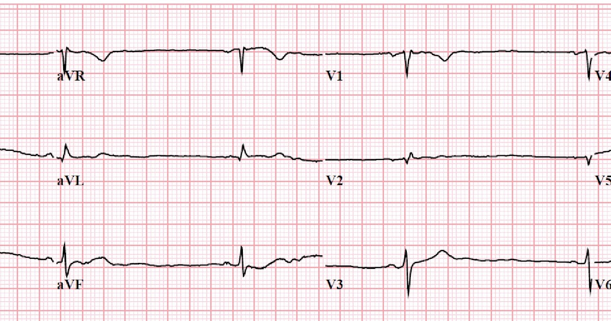 Emergency Medicine Curiosa Sinus Bradycardia And Lithium Toxicity At emergency-medicine-curiosa-sinus-bradycardia-and-lithium-toxicity-at